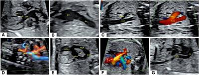 Prenatal echocardiography diagnosis of a novel combination of bilateral ductus arteriosus and cardiovascular anomalies: a case report and literature review